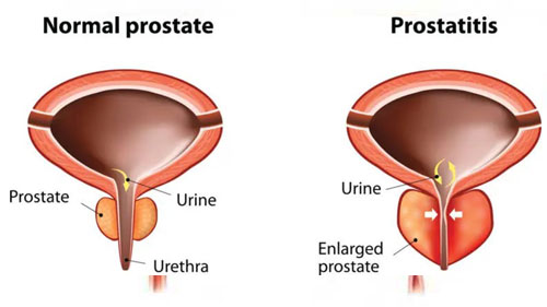 Enlarged Prostate