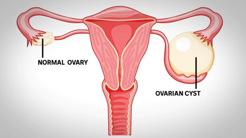  Ovarian Cyst