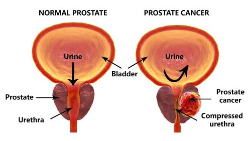 Prostate Cancer Treatment in Nagpur