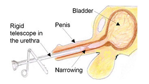 Ureteric Stricture