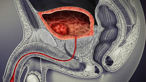 Urinary Bladder Cancer 