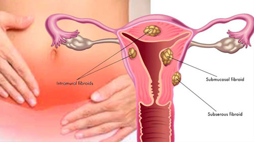 Uterine Fibroid