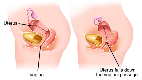 Uterine Prolapse